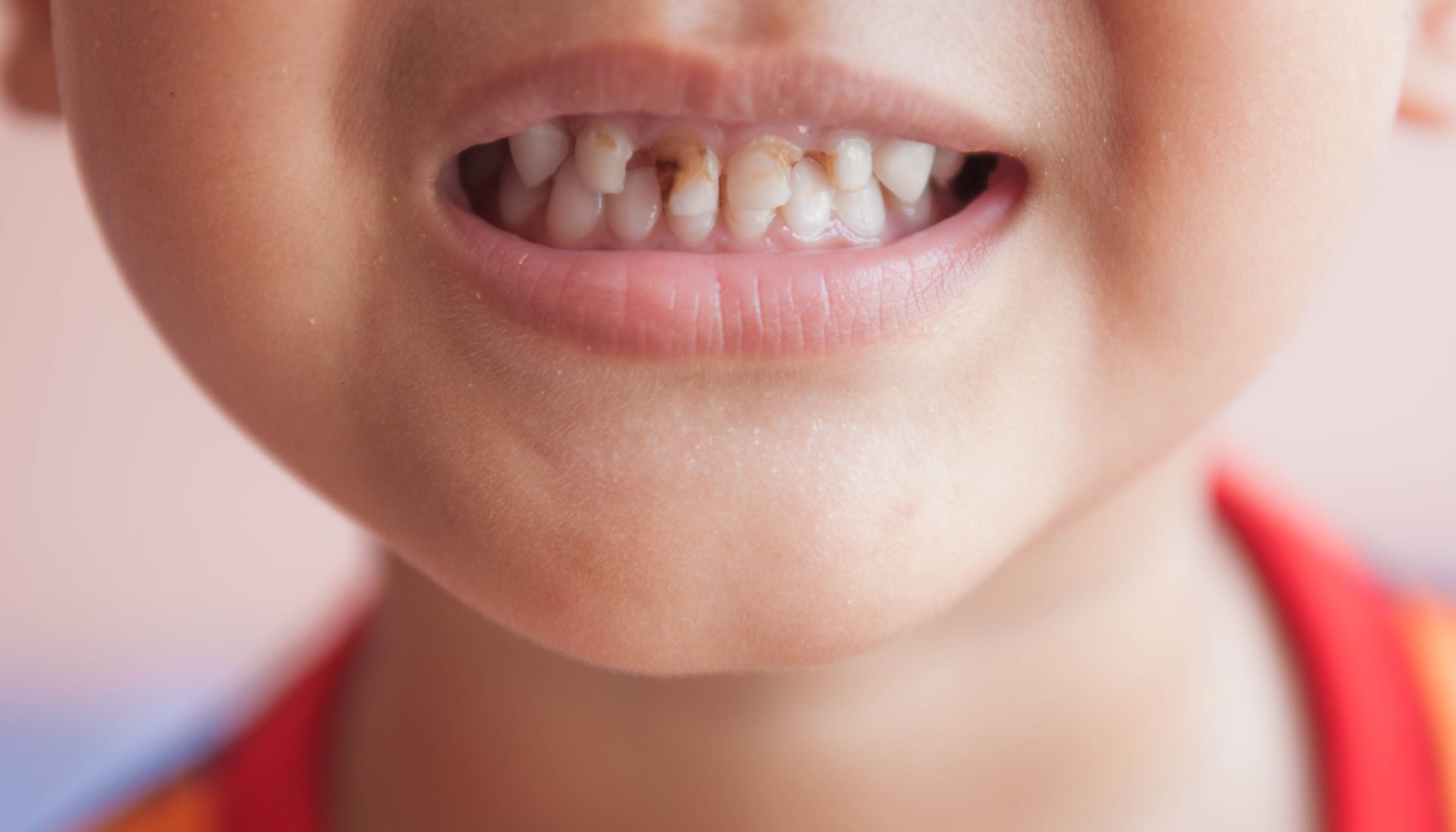 Barn viser frem misfargede melketenner med tydelig hull og brun skade på flere av fortennene. hull i tennene barn hull i tennene få hull i tennene sukkerholdig mat og drikke mat og drikke to ganger daglig tannlege eller tannpleier to ganger to ganger om dagen hos barn tennene hull morgen og kveld mer utsatt inntak av sukkerholdig forebygge hull flekker på tennene pusser tennene får hull karies inneholder mye hos tannlegen barnet barn bør hos tenner tannen får tannlege tannlegen mer viktig sukker tannpuss dersom fluor unngå munnen ofte bruk behandling tannråte utsatt andre kosthold mye gjør barnets emaljen syre god gir små vann risikoen måneder kommer ekstra større fluortannkrem flere pusser risiko derfor tegn inneholder forebygge natten behov finnes eksempel trenger tannverk gode måltider bryter tid symptomer tannkrem bakterier