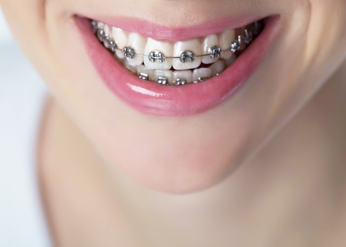 How Much Are Braces UK