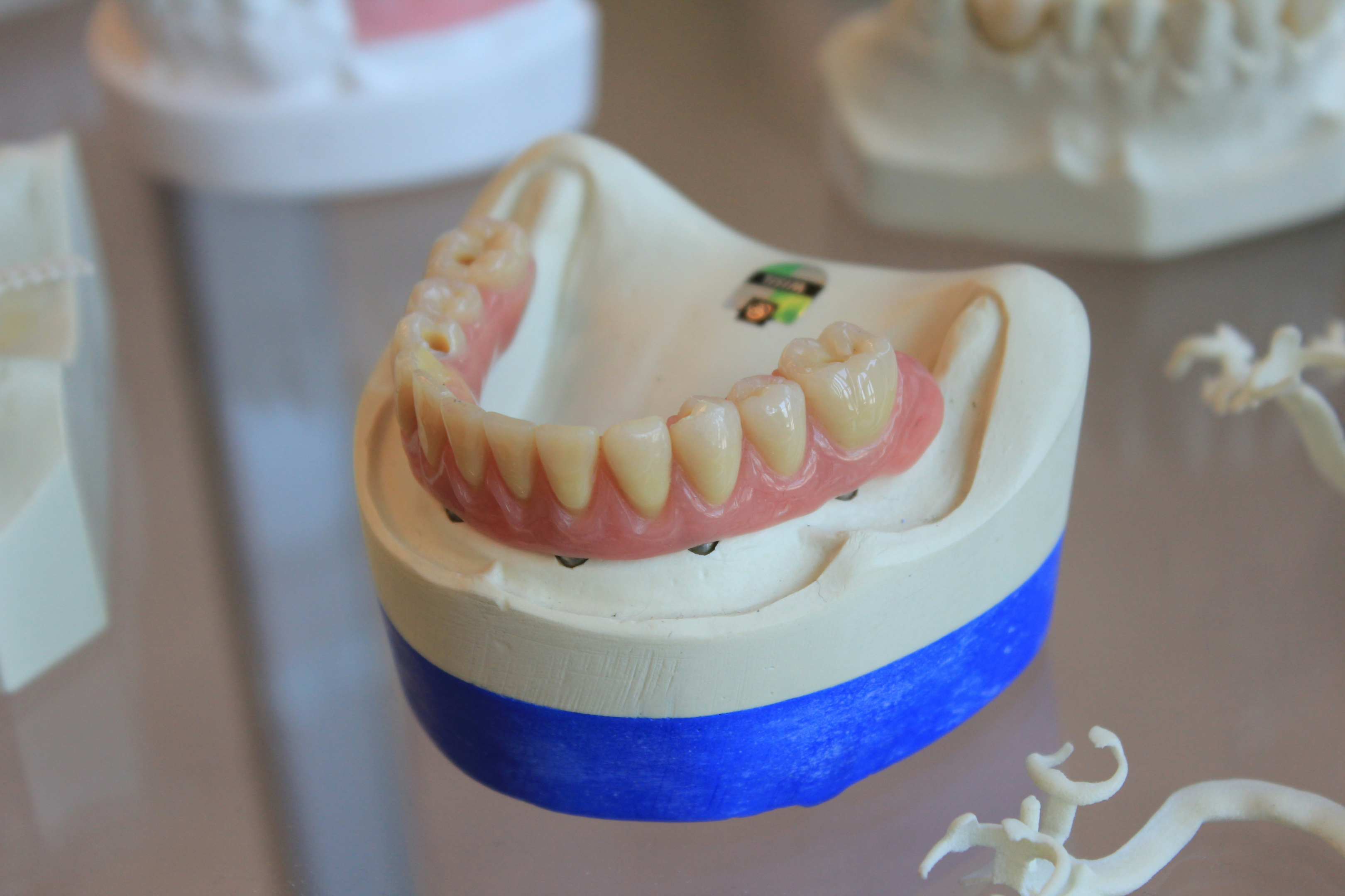 a model of a denture supported by titanium metal dental implants replacing several teeth