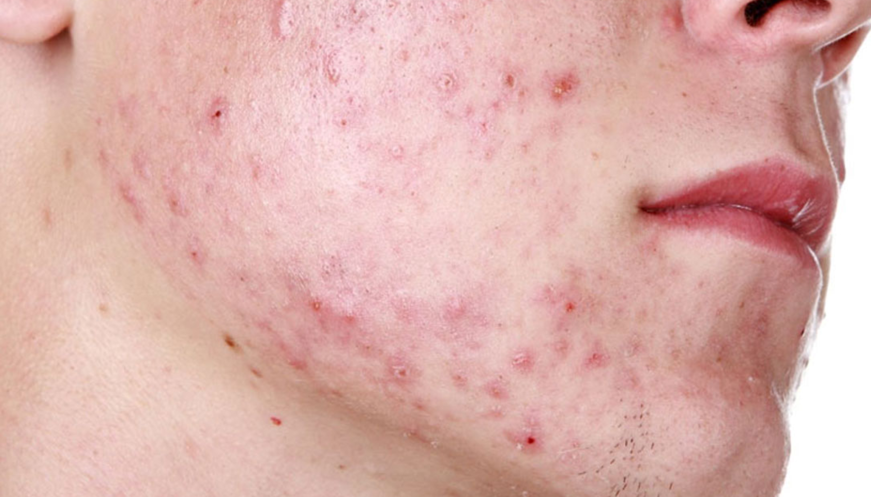 "Ansikt med utbredt akne og betente røde prikker på kinn og hake."