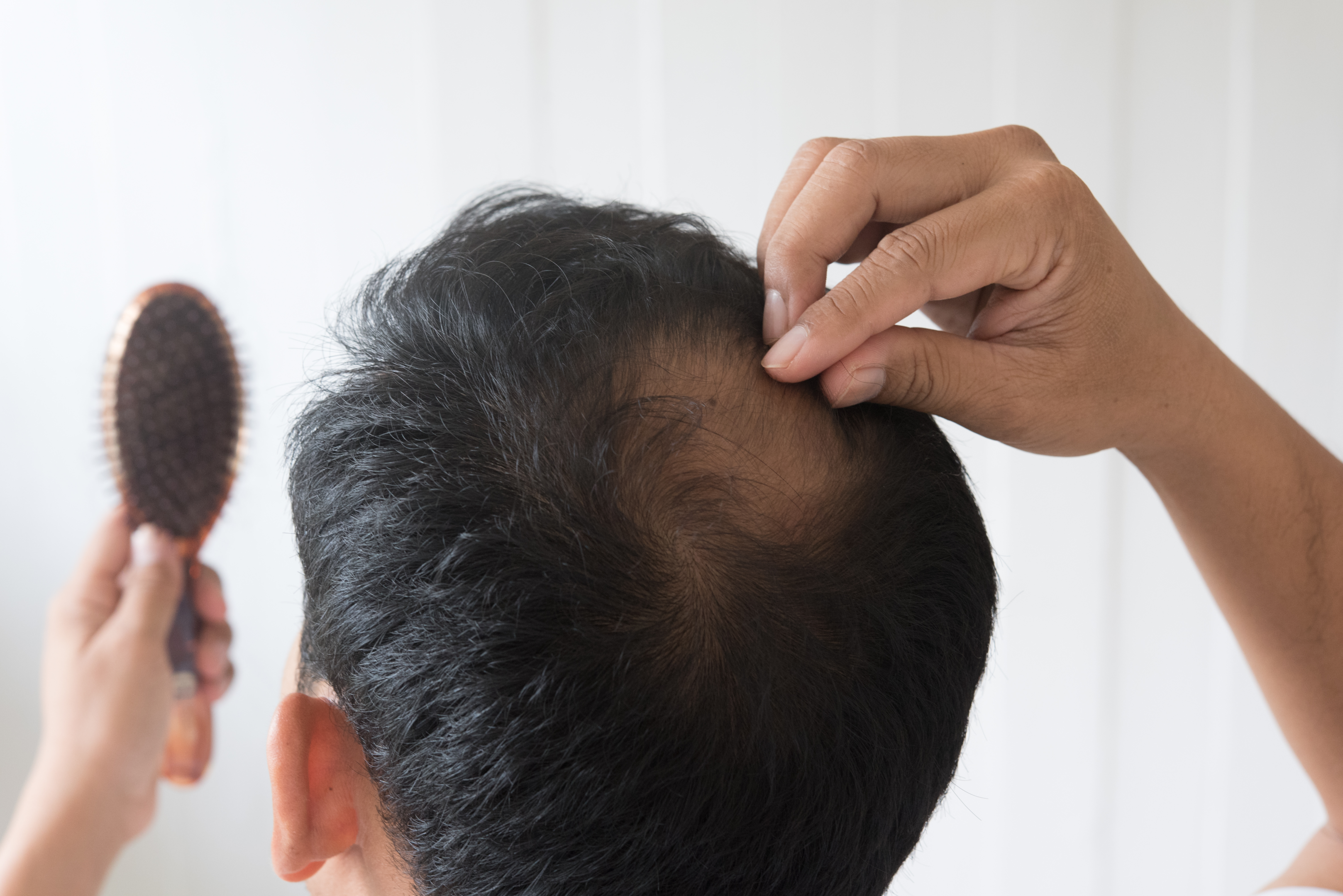 hair follicle growth can be impacted by male pattern baldness and female pattern baldness 