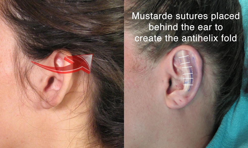 Mustarde Antihelix Otoplasty Case Study San Diego CA