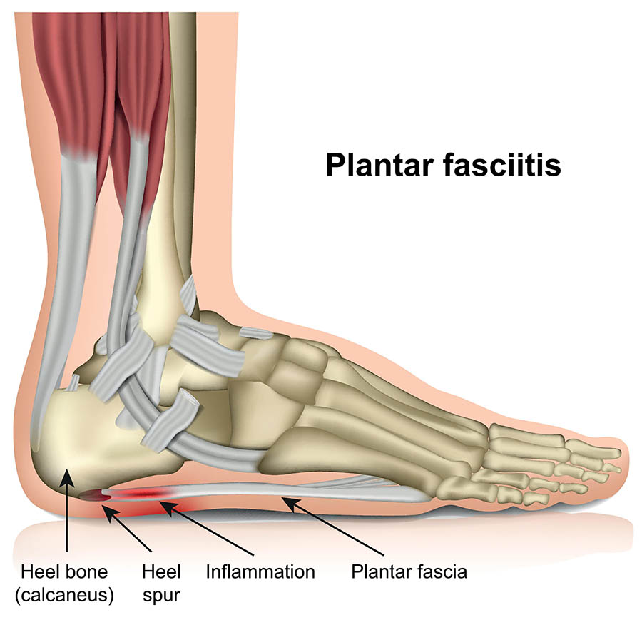 Plantar Fasciitis - How to make it suck a little bit less - PRP Physio