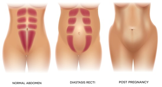 La imagen muestra la evolución del abdomen durante el embarazo, destacando el estado normal, la aparición de diástasis de rectos (una separación de los músculos abdominales común durante el embarazo) y la recuperación típica después del embarazo.