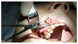 Extração do dente siso