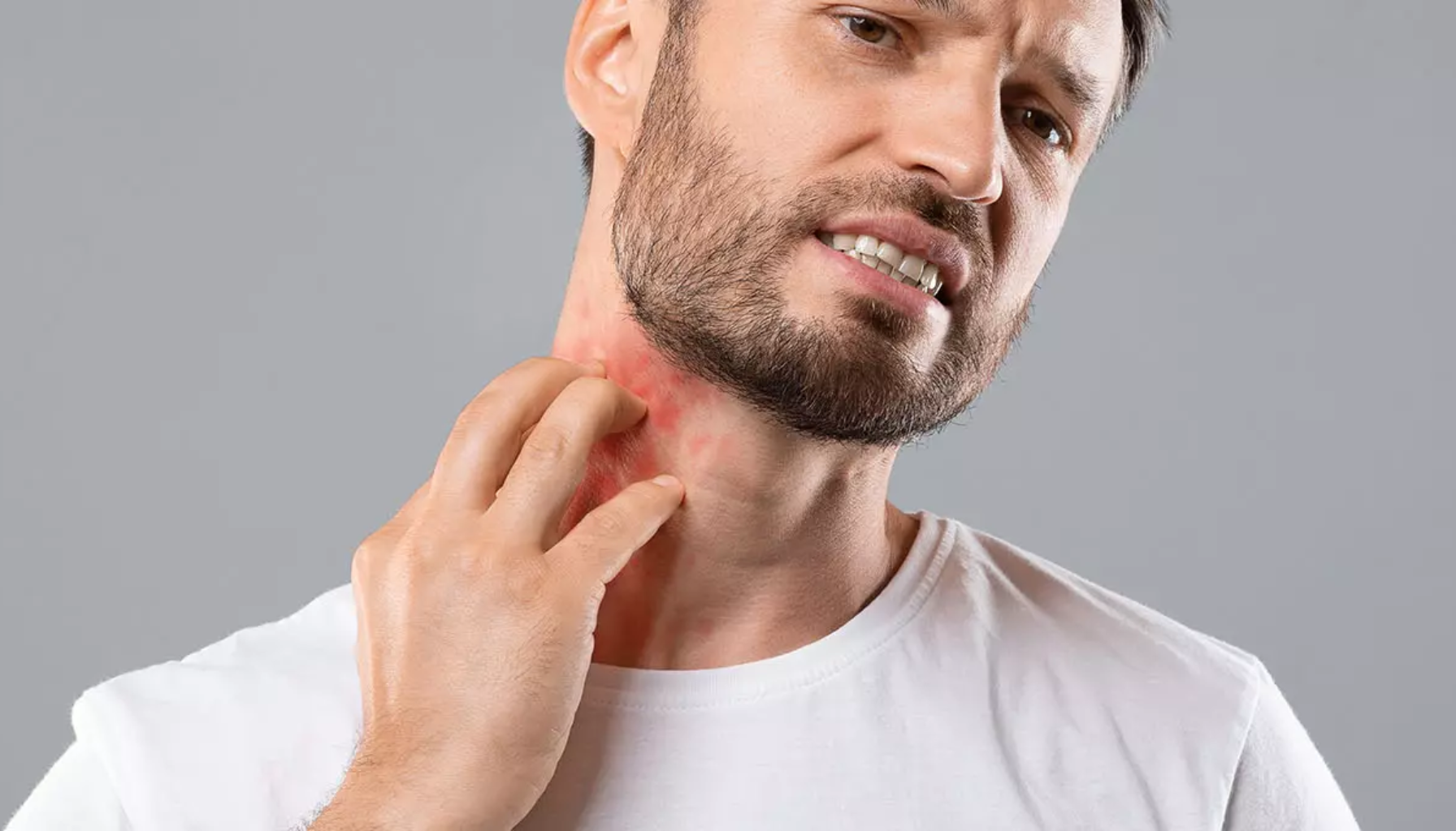 Stevens-Johnsons syndrom: En alvorlig reaksjon Stevens-Johnsons syndrom: En alvorlig reaksjon