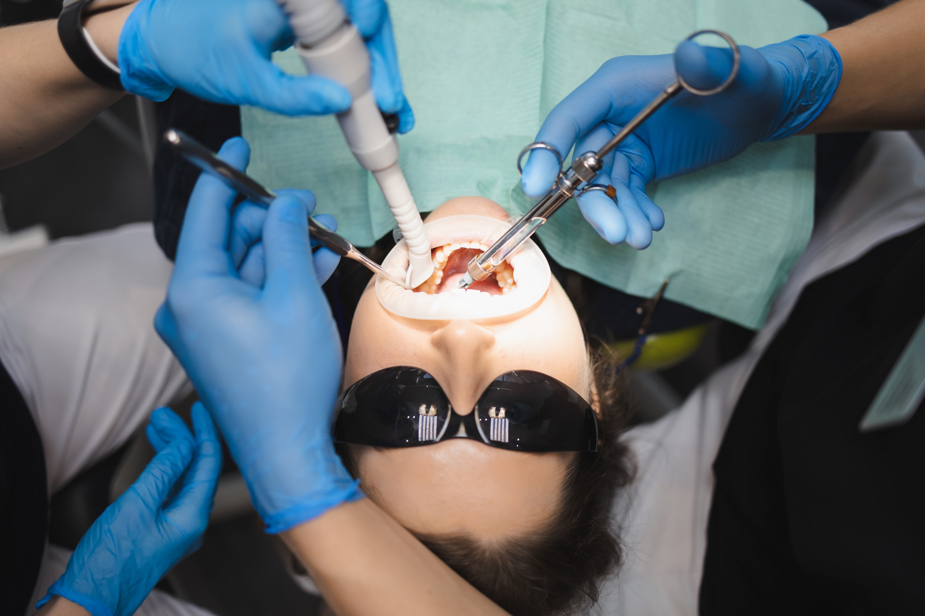 An image of a woman about to remove the four wisdom teeth.