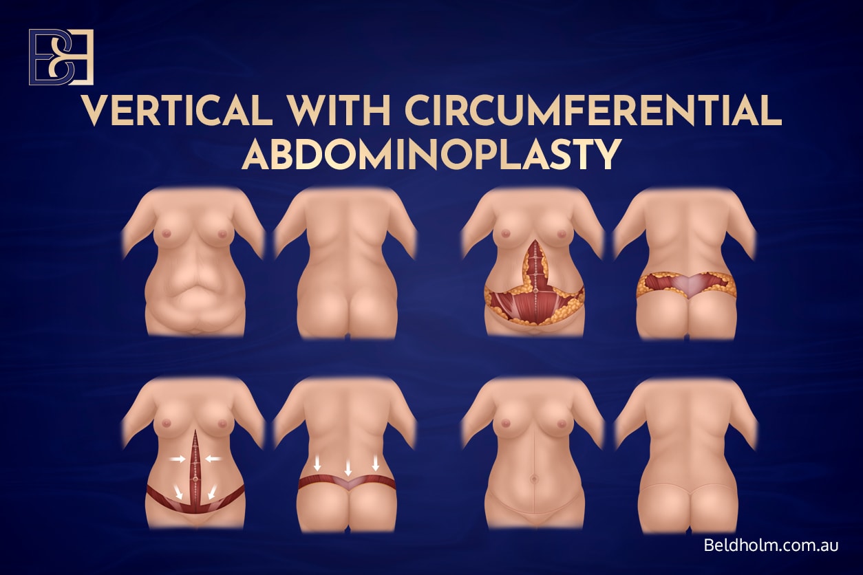 Circumferential hybrid abdominoplasty