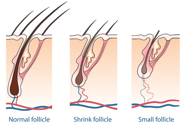 hair loss and trt / testosterone 