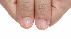 brittle nails, nail growth, thyroid disease, skin conditions