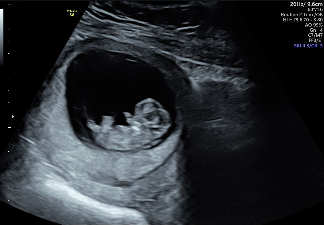 10 week early ultrasound scan photo
