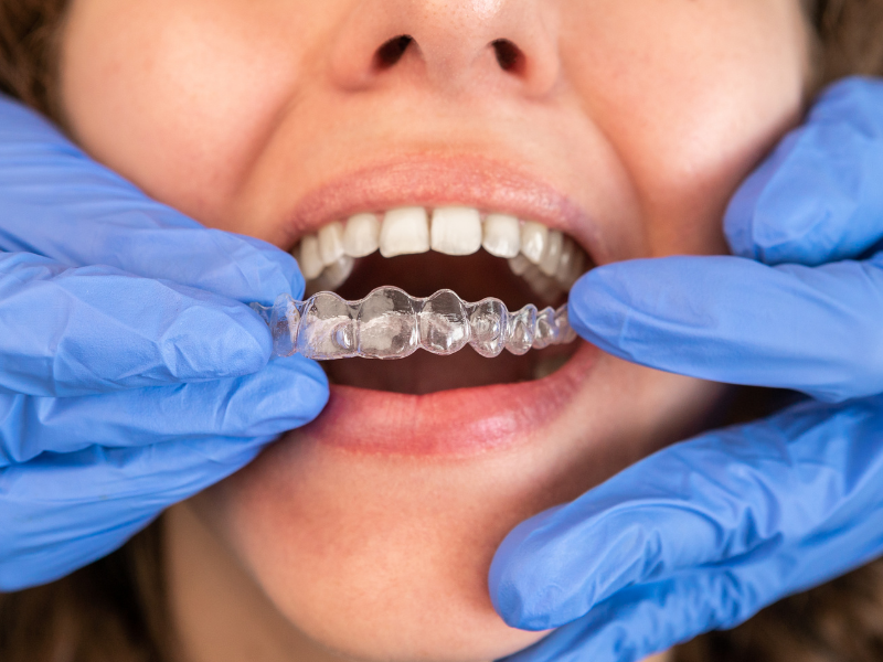 Picture of invisalign aligners used to fix an underbite.