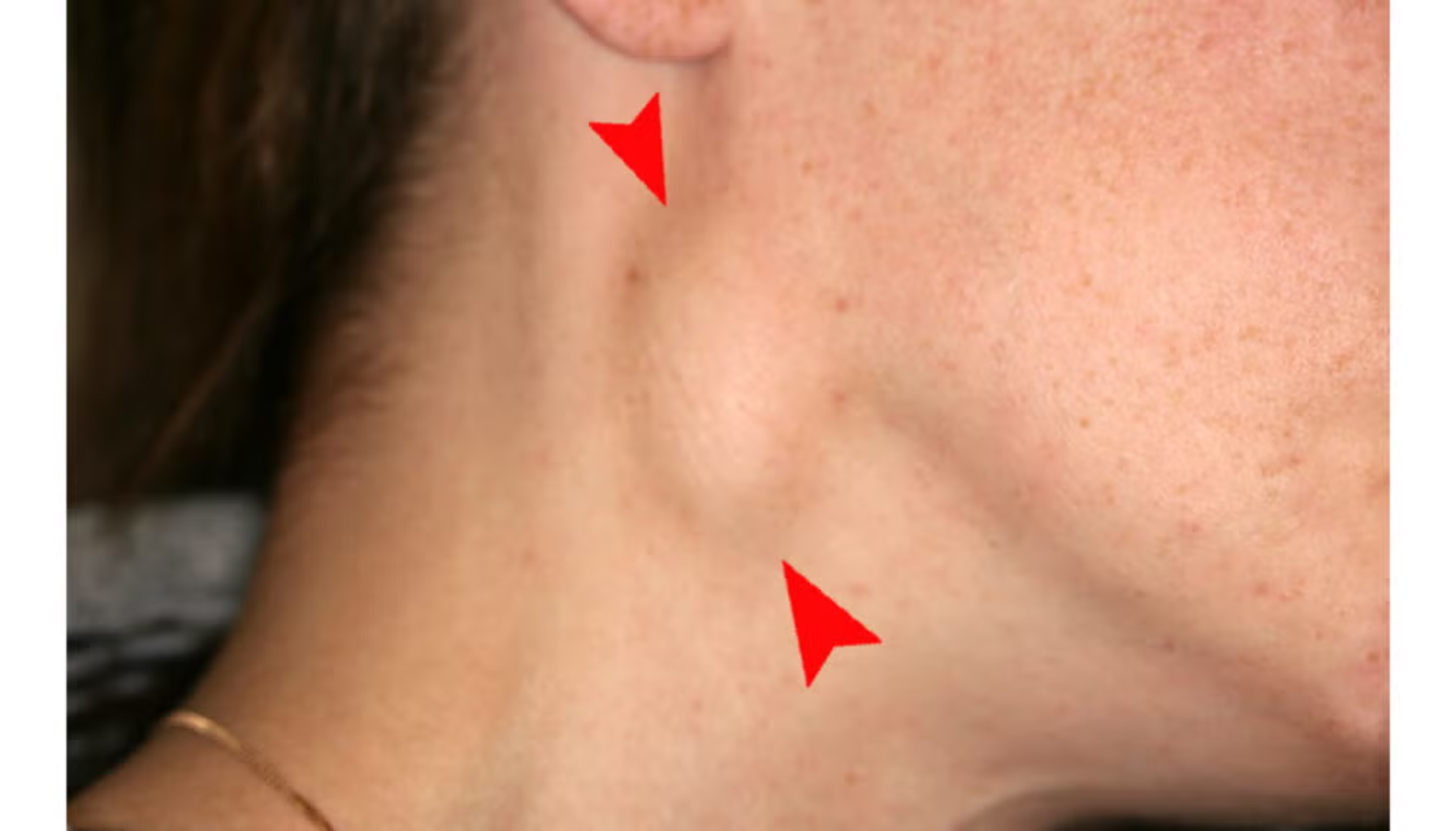Lymfeknuter: Når Du Bør Være Bekymret for Hevelser i Halsen 10 Nærbilde av hals med hovne lymfeknuter markert med røde piler, tydelig synlig under huden.