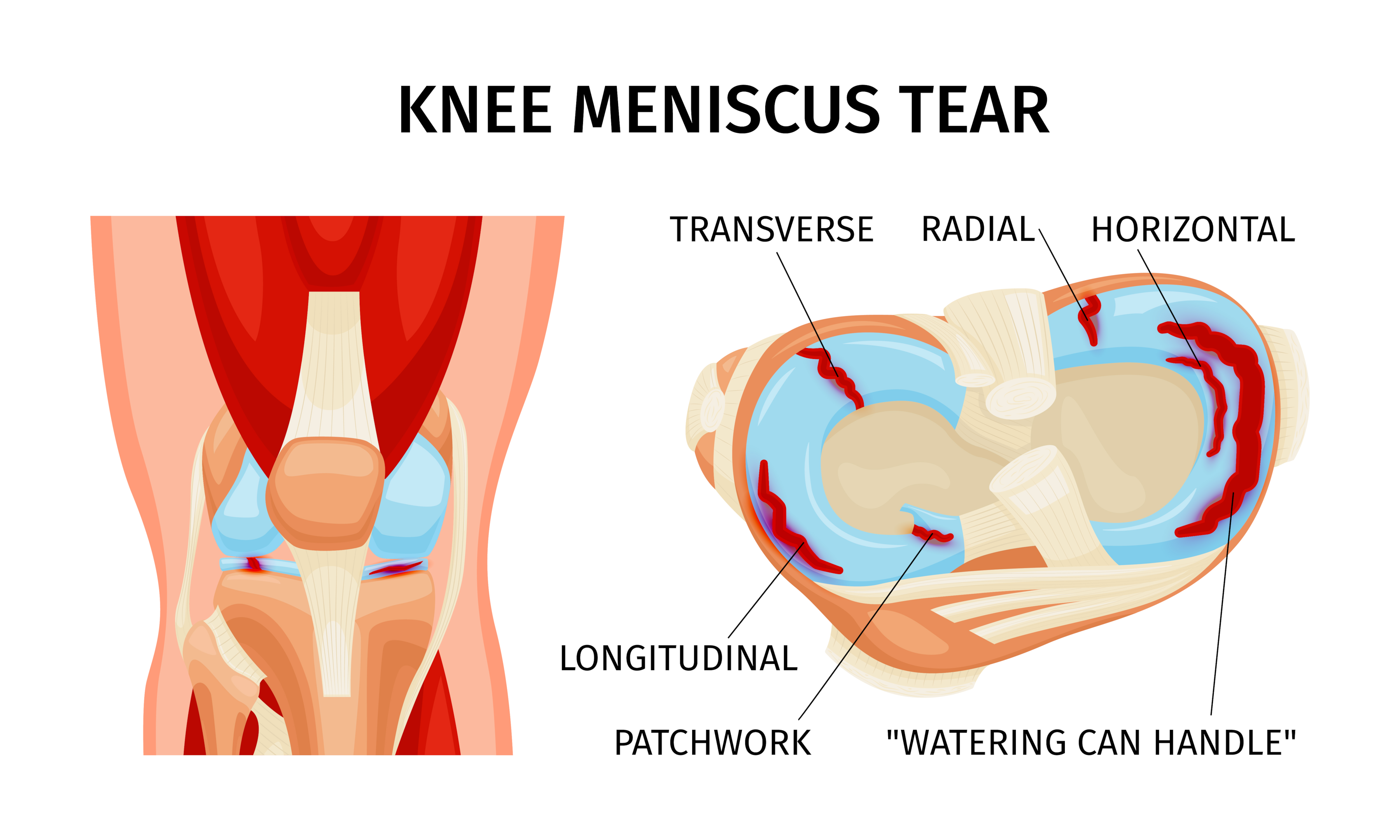 Knee meniscus tear anatomy diagram