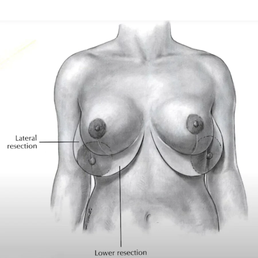 Una mujer con un levantamiento de senos sin implantes, mostrando el exceso de piel que se elimina durante el procedimiento