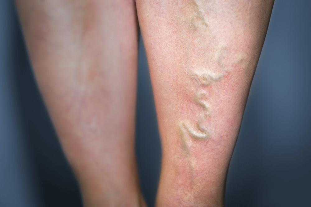 Vein Treatment At Vascular Institute