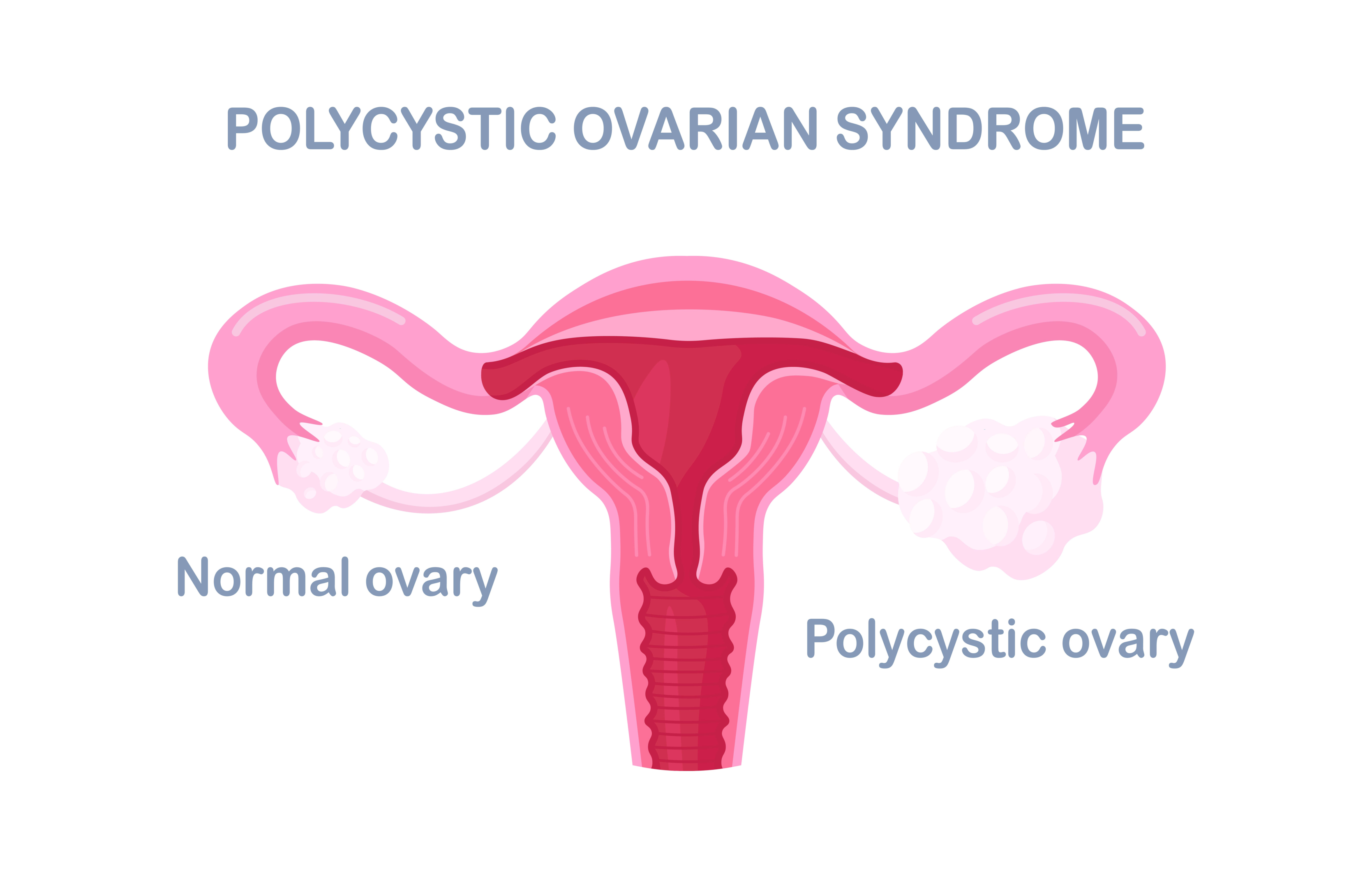 Illustrates of a polycystic ovary against a normal ovary.