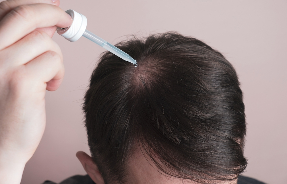 Oral medications to treat androgenetic alopecia