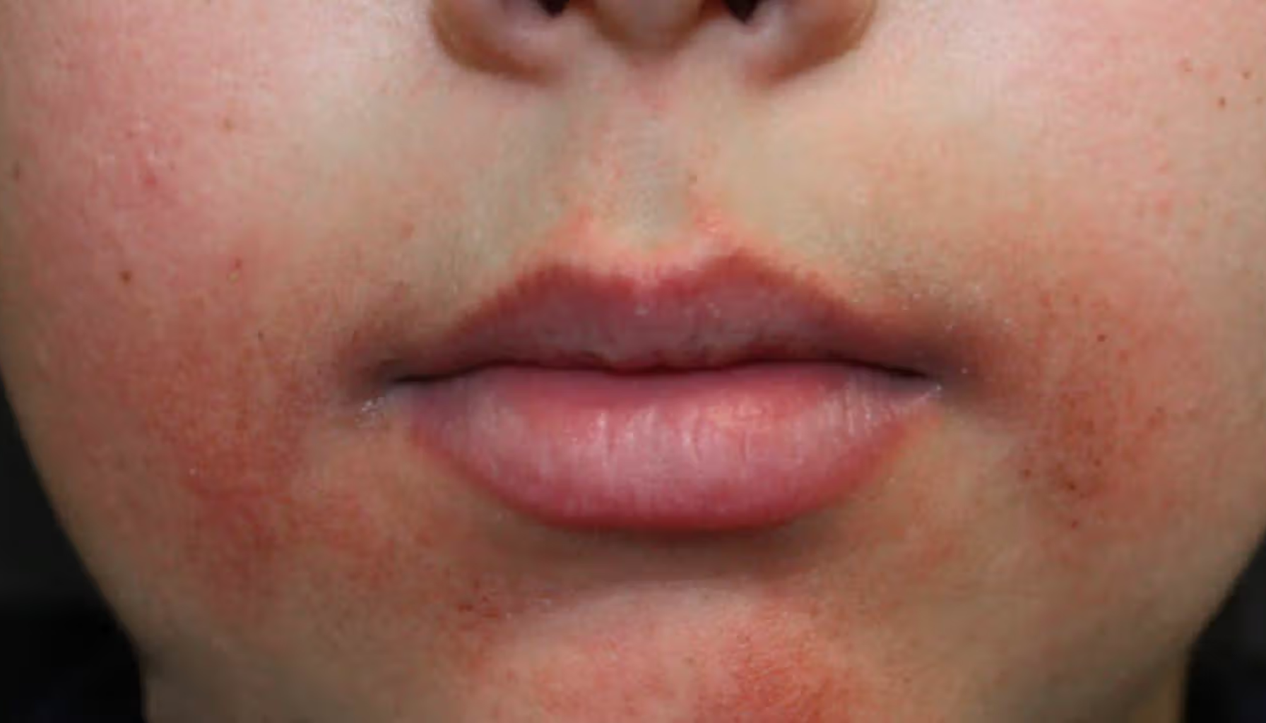 Rødlig og irritert hud rundt munn og hake, karakteristisk for perioral dermatitt hos ung person.