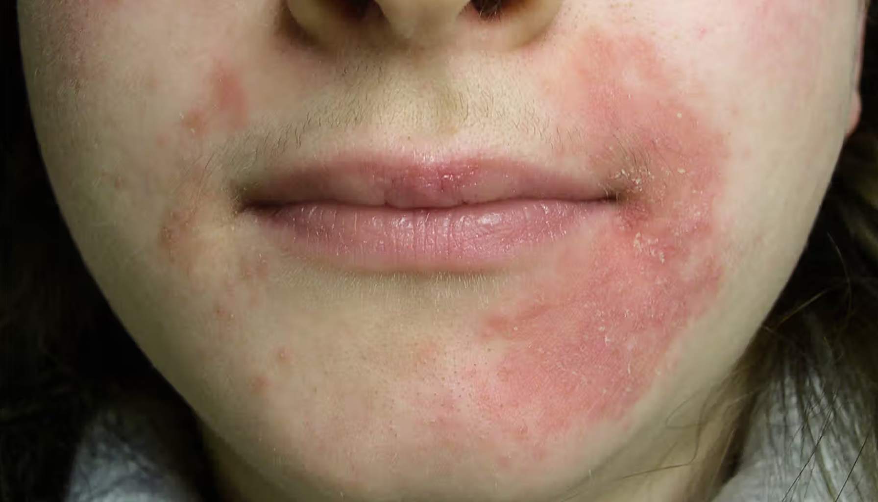 Periorifisiell Dermatitt: Det Uforklarlige Utslettet Rundt Munnen 13 Rødlig utslett og irritasjon rundt munnen og på kinnet, typisk for perioral dermatitt hos ung voksen.