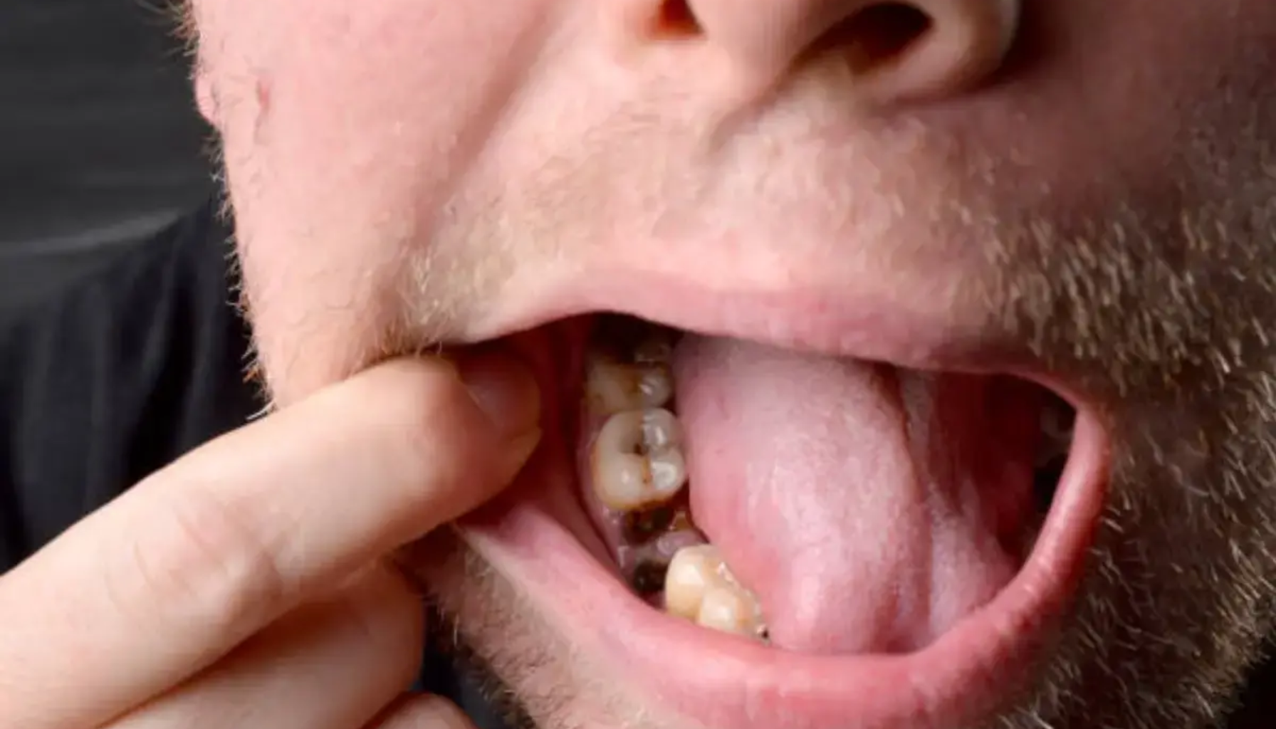 Nærbilde av åpen munn med finger som trekker kinnet til side, viser tydelig råtne og skadede tenner.