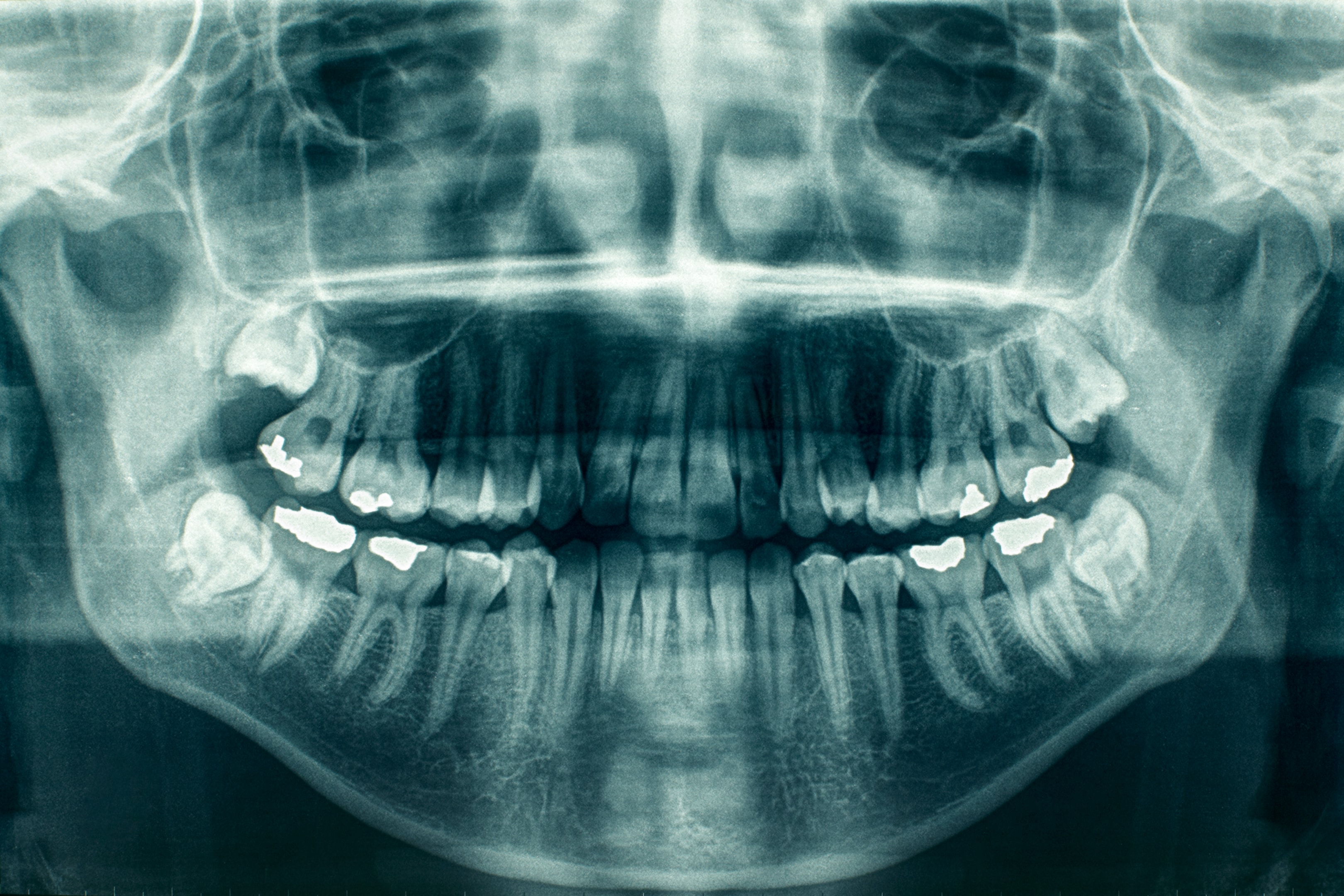 x-ray showing all your teeth including your wisdom teeth