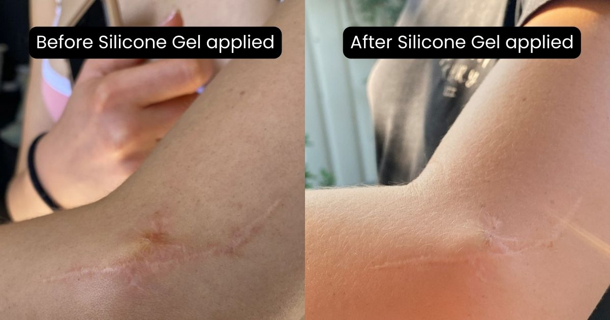 Before and after image of Genova silicone gel
