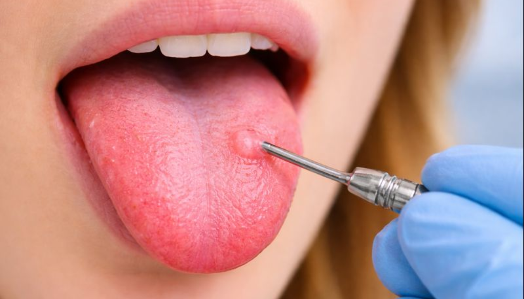 Kul på Tunga: Når En Liten Opphøyning Trenger Oppmerksomhet 11 Tannlege undersøker liten kul på tungen med instrument, betent område synlig, nærbilde med fokus på tungen.