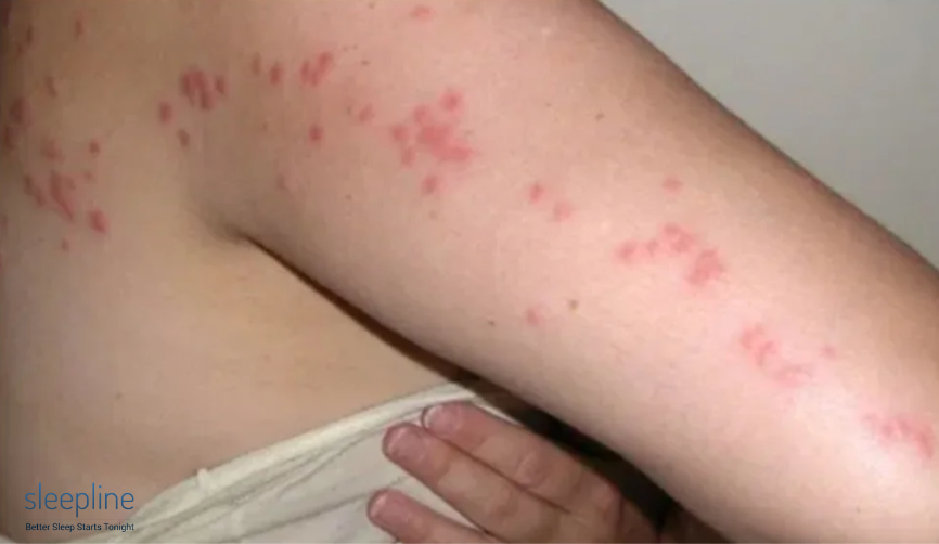 Bed bug bites on a person's skin