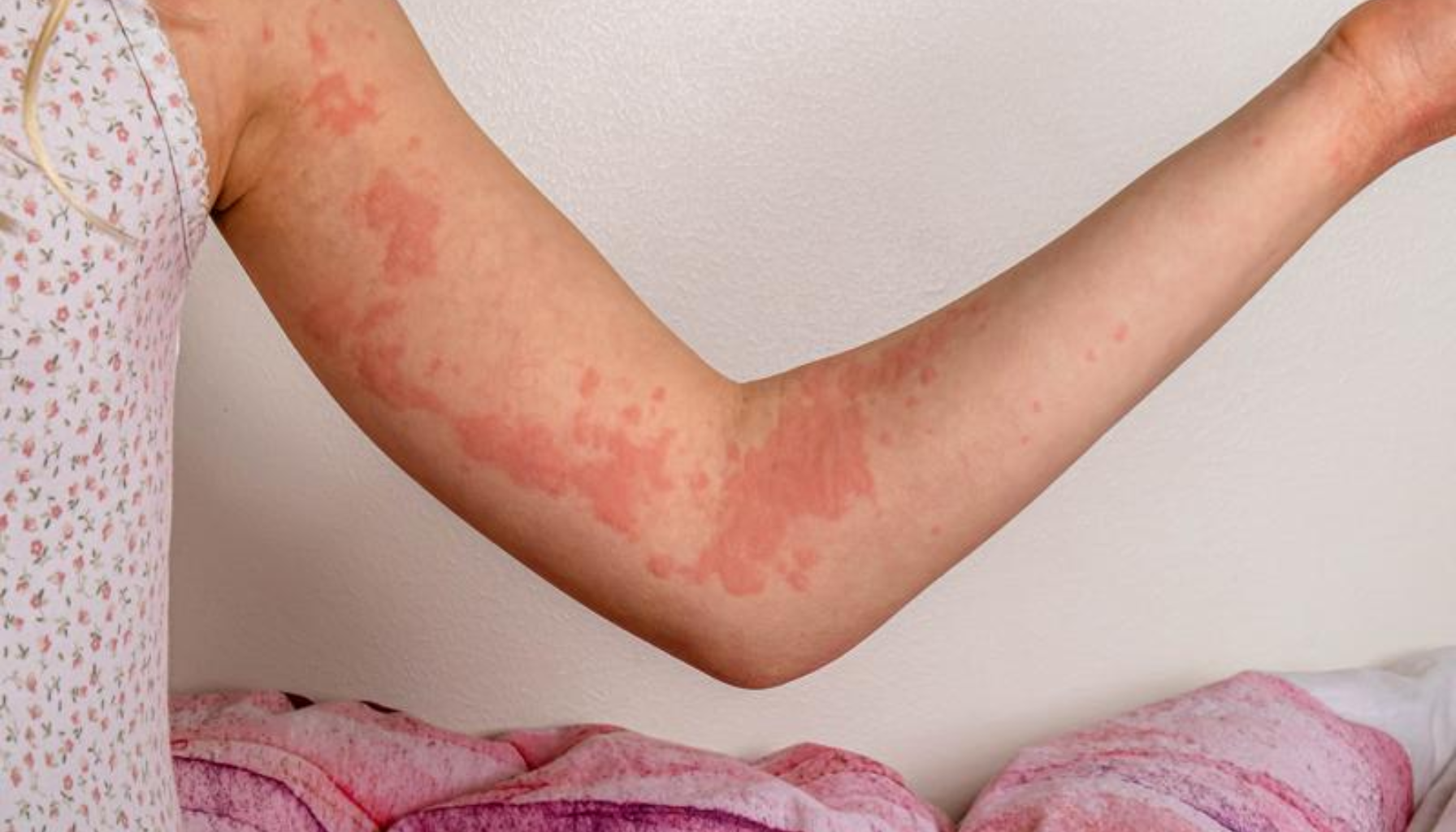 Bildet viser en arm med røde, ujevne utslett og flekker på huden, som kan være tegn på allergisk reaksjon, eksem eller elveblest.