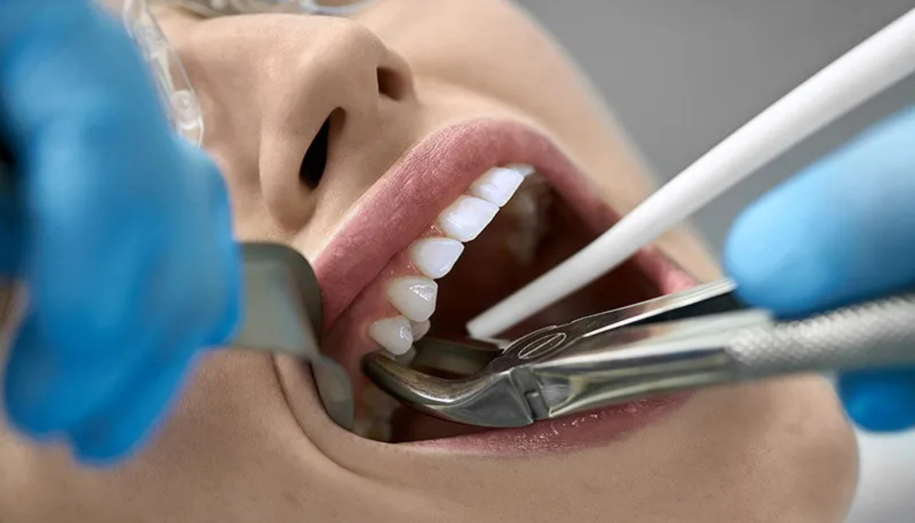 Refusjon ved trekking av tenner – Dette må du vite