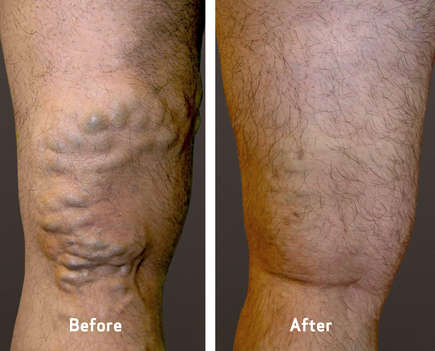 What To Expect After Varicose Vein Treatment