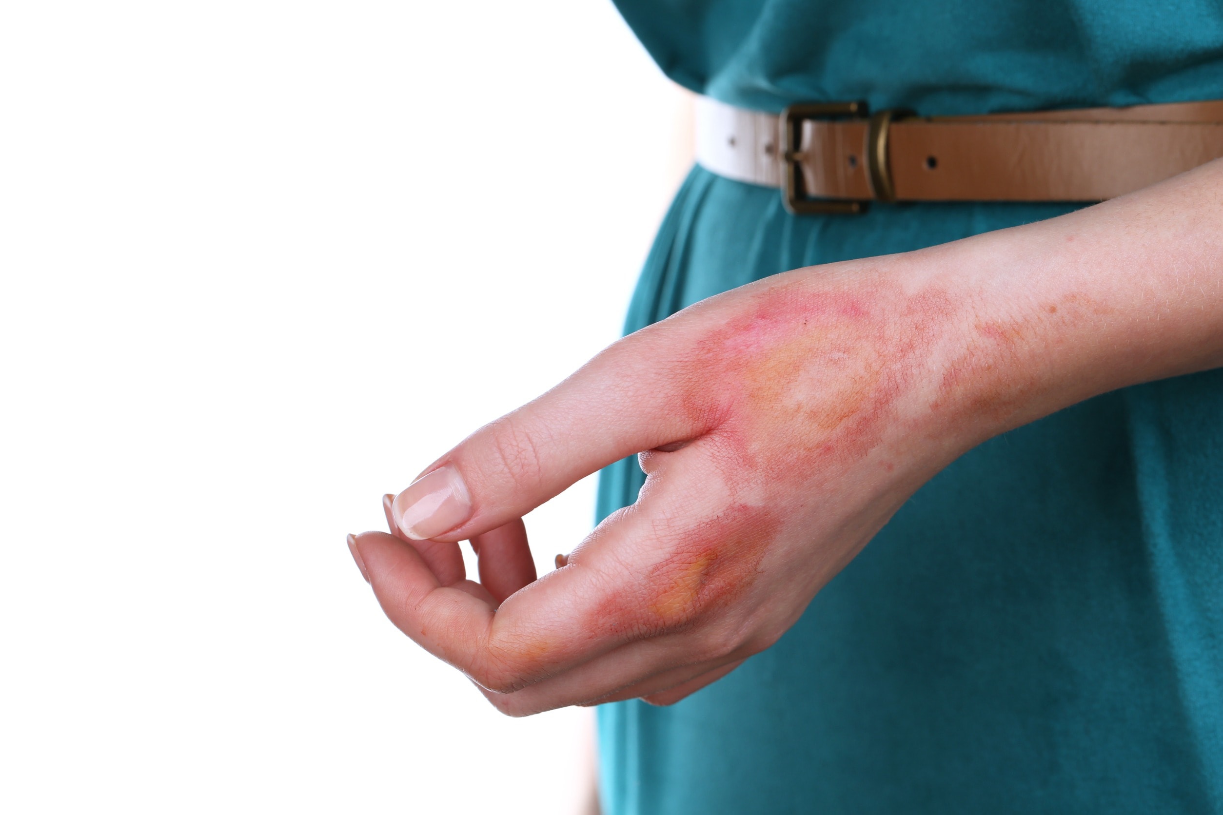 A second degree burn illustrated on a burn victims hand