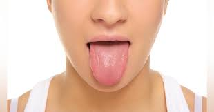 poor oral hygiene, cracked tongue, oral hygiene, oral medicine, tongue health, tongue's surface, burning tongue, topical antifungal medication
