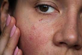 tips for pitta sensitive or combination skin