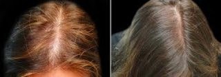 celulas-madre-para-alopecia-madrid