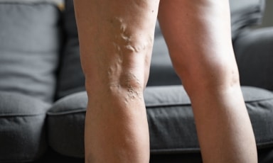 Zdjęcie poglądowe przedstawiające żylaki nóg