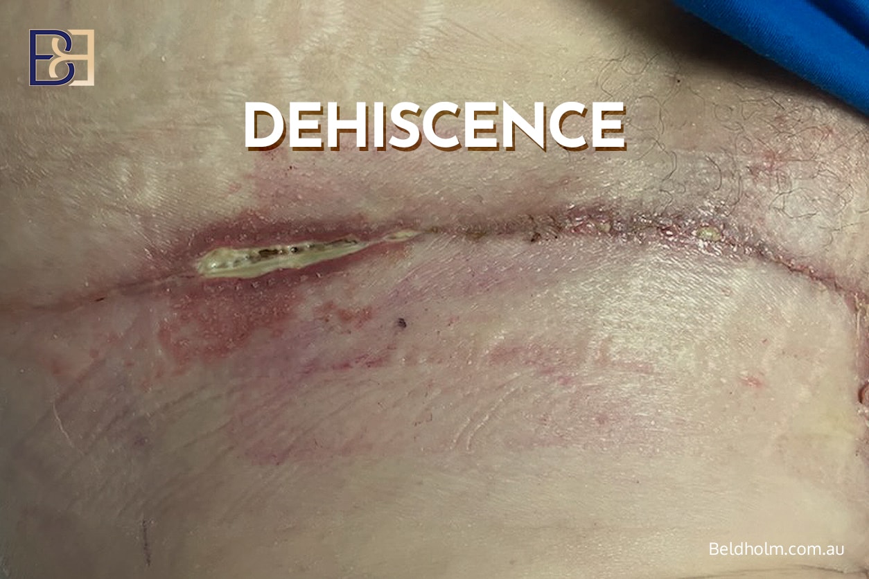 Complications After Thighplasty: Risks, Causes, and Management Options 4 wound breakdown (wound dehiscence)