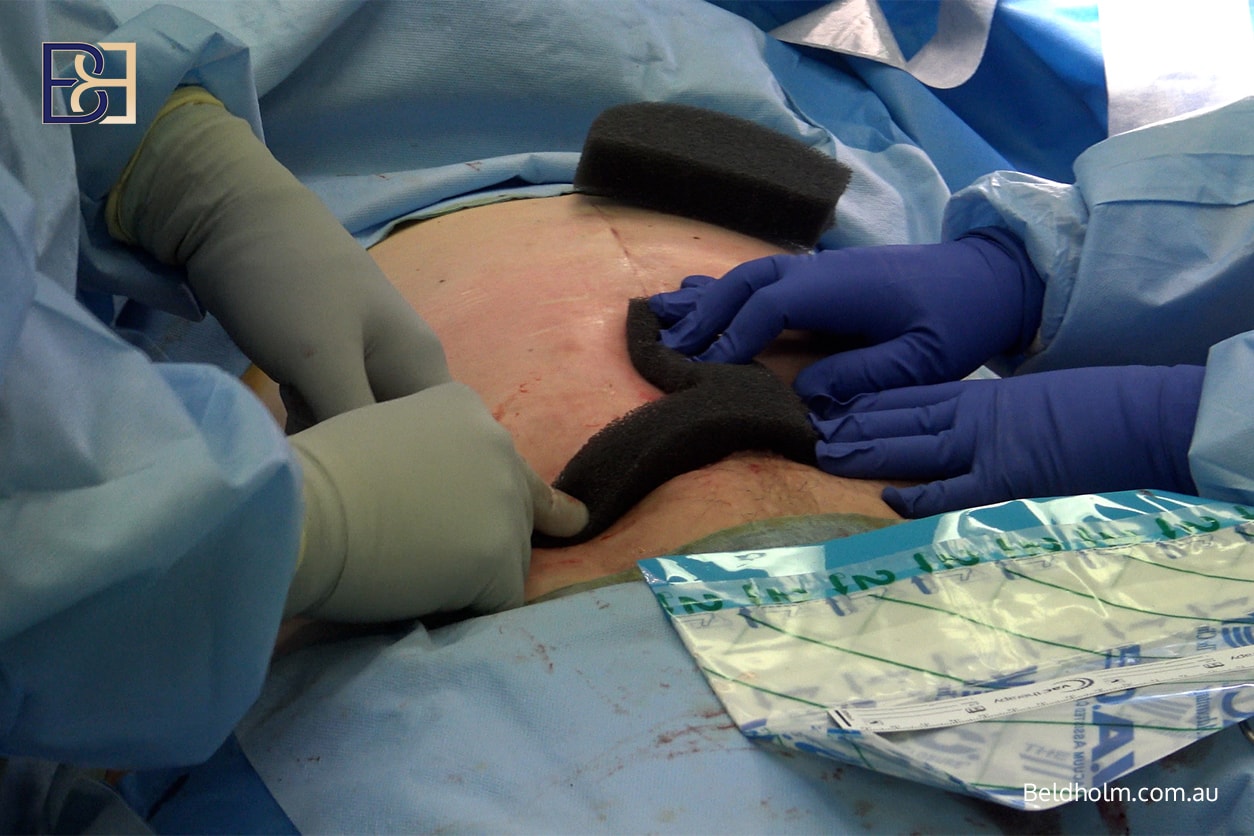 Complications for Upper and Lower Abdominal Lipectomy Post Weight Loss 5 wound breakdown | Dr Bernard Beldholm