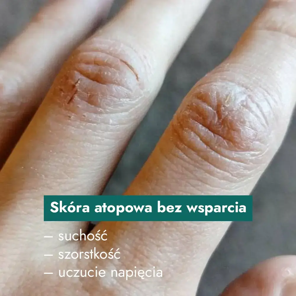 objawy atopowego zapalenia skóry