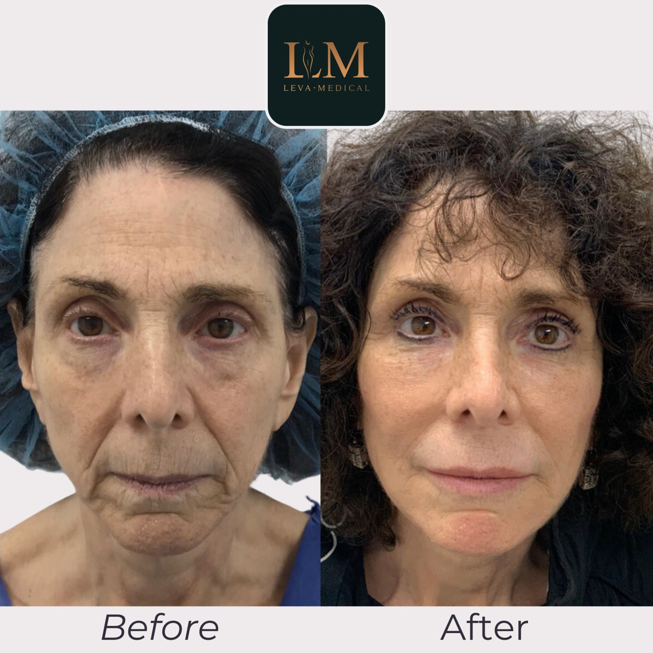 Foto de fotos de antes y después de pacientes con transferencia de grasa facial.