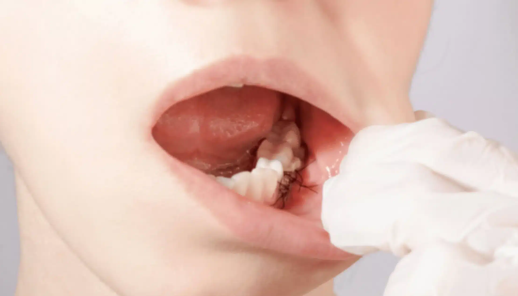 "Nærbilde av munn etter tannkirurgi med synlige sting i tannkjøttet."