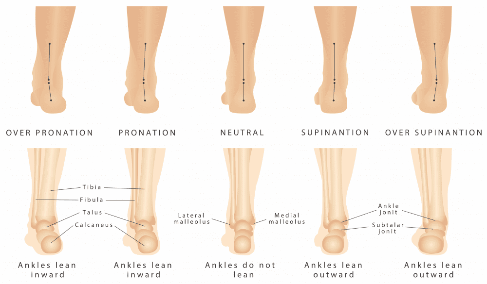 Managing your Plantar Fasciitis - Brisbane Physiotherapy