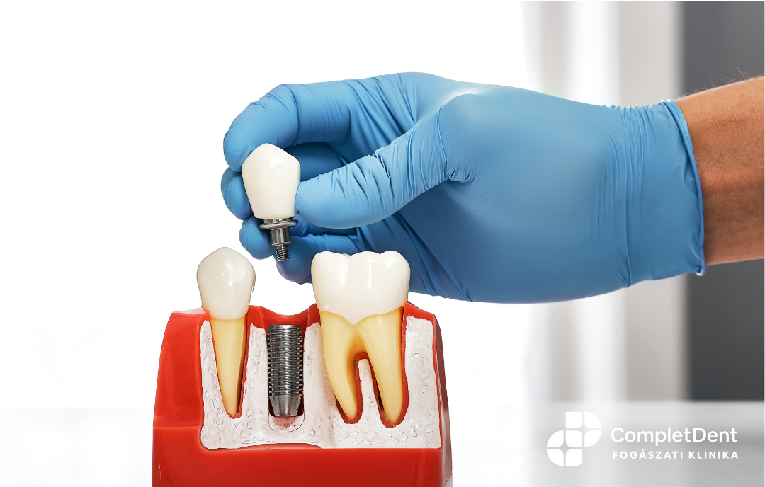 A fogászati implantátum tartós és esztétikus megoldás