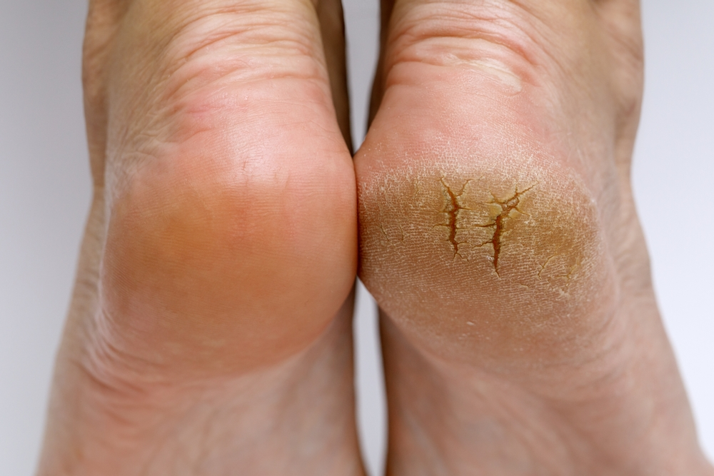 diabetes affects foot temperature and skin health