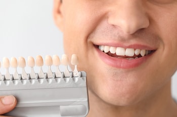 composite resin veneers