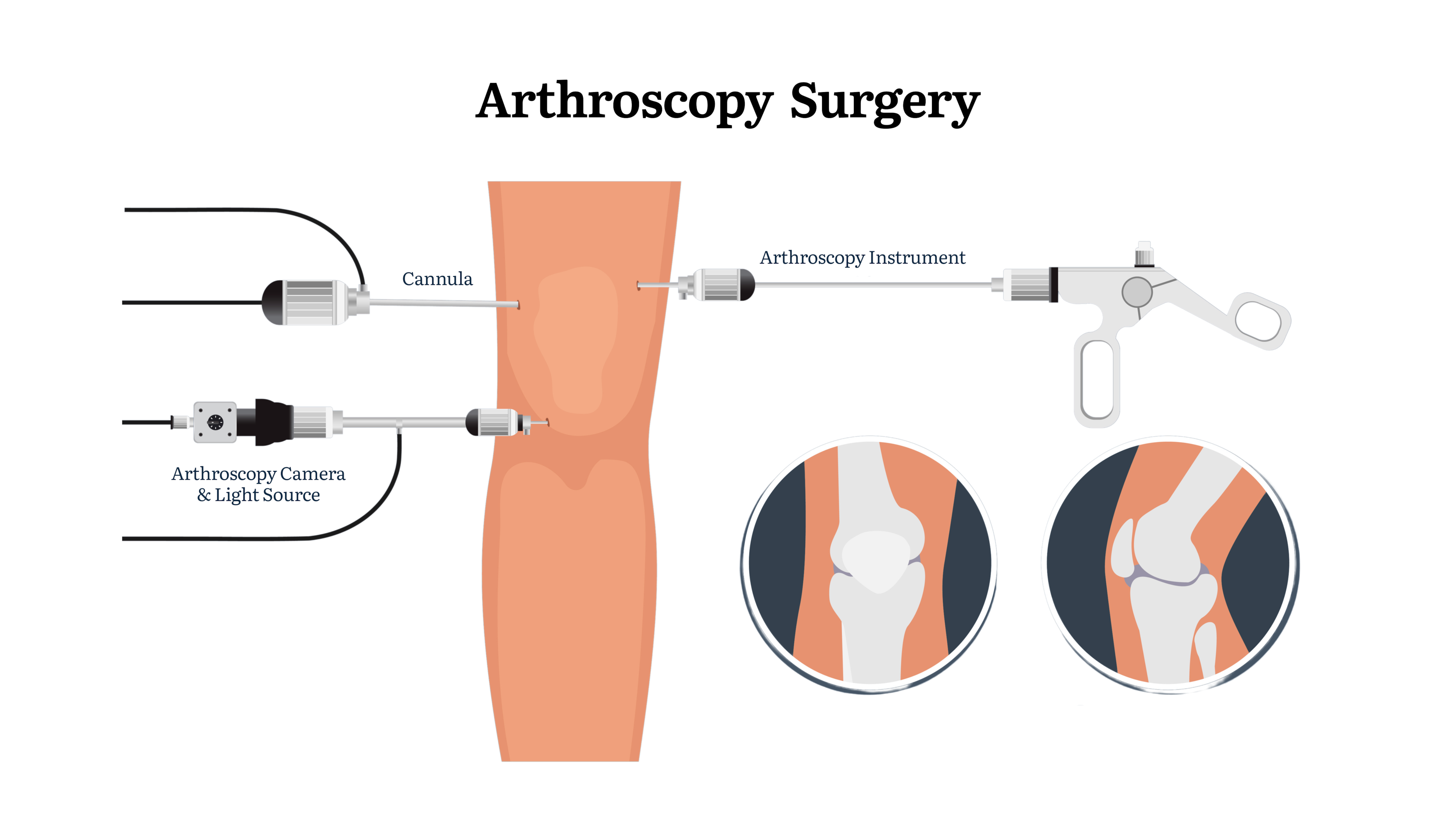 Can Arthroscopy Protect Your Knees and Long-Term Performance?