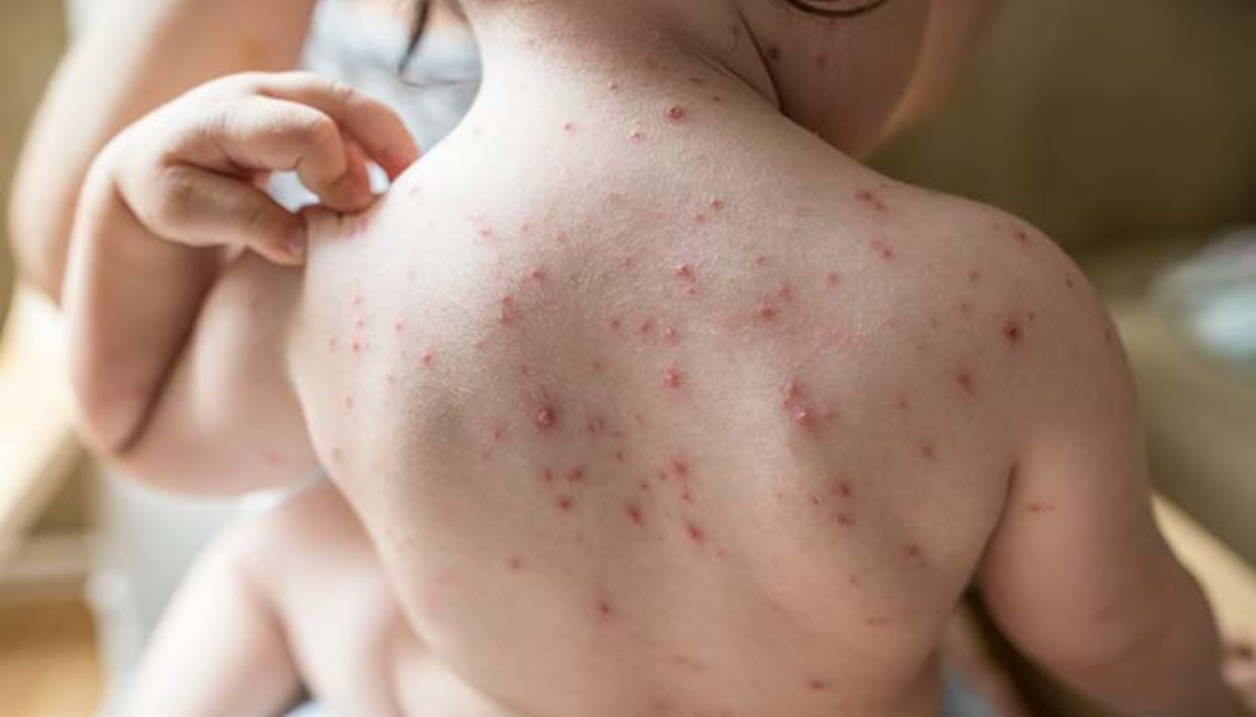 Liten barnerygg dekket av rødt utslett og blemmer, typisk for vannkopper. Barnet klør seg på huden med hånden. Ask ChatGPT