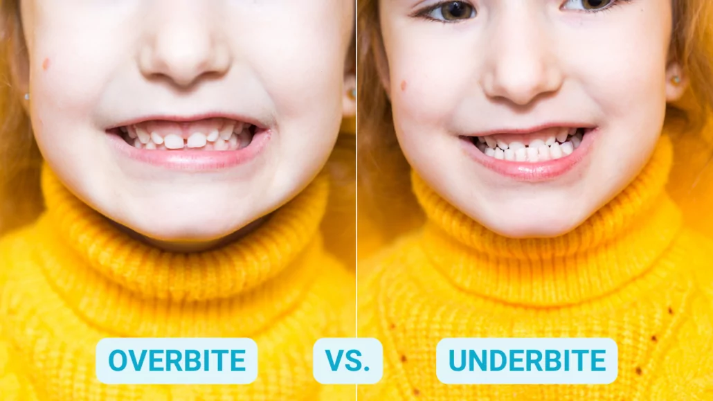 Kid smiling with an underbite and an overbite