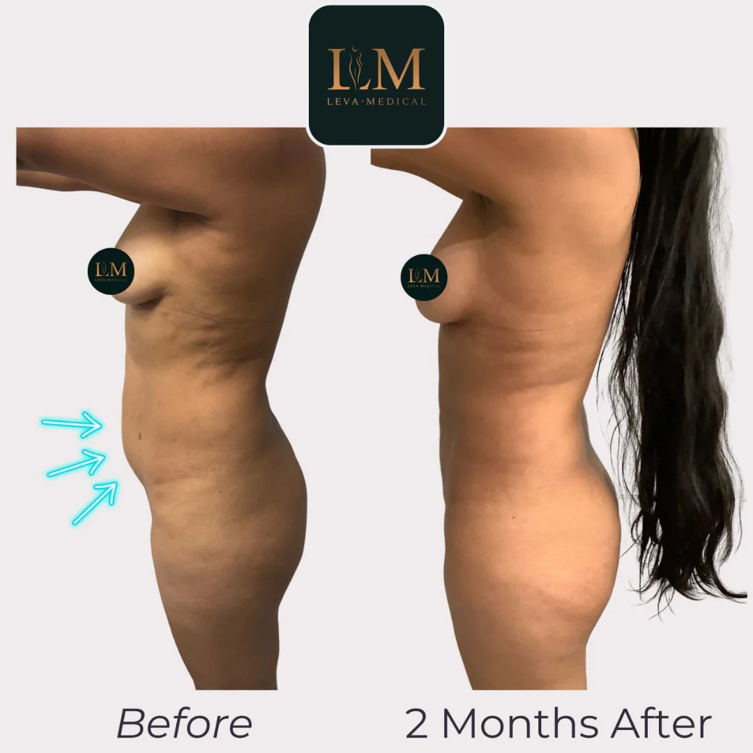 A doctor comparing J Plasma liposuction to traditional liposuction